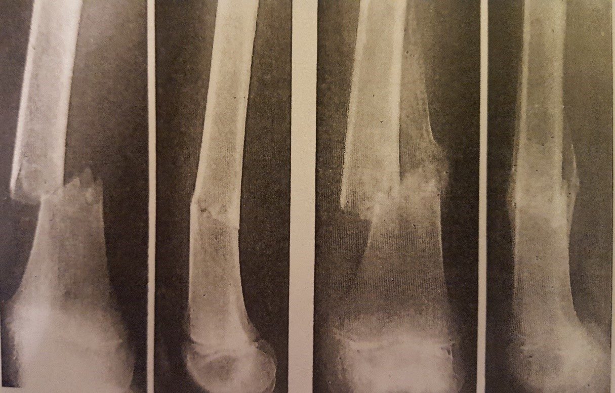 Featured image: Pathology of Fractures and Fracture Healing