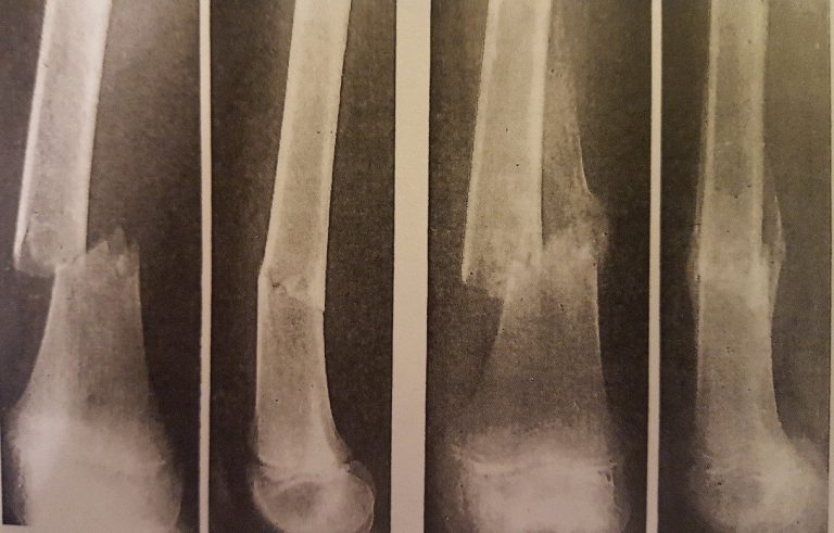 Pathology of Fractures and Fracture Healing