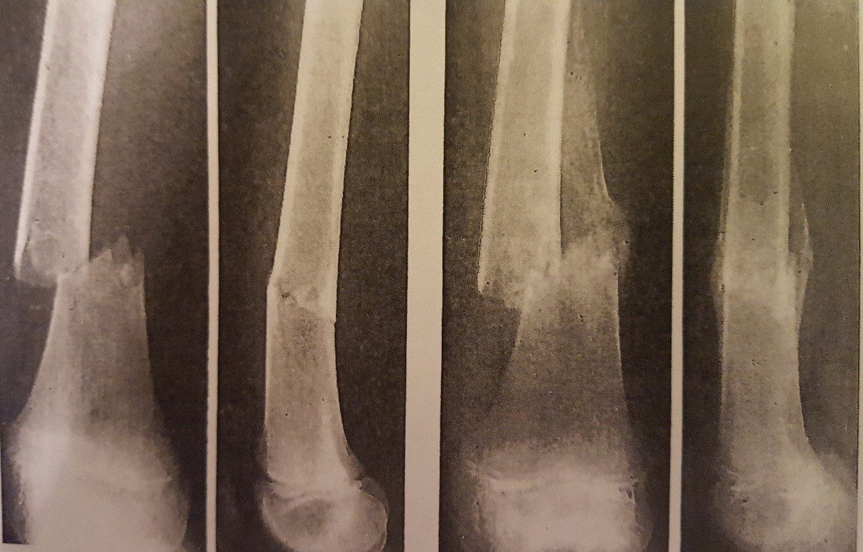 bone remodeling x ray