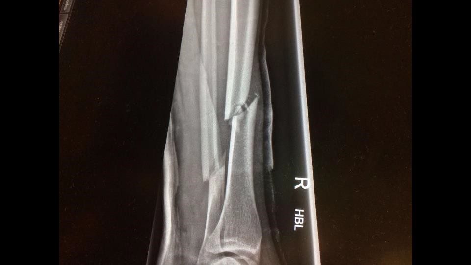 x-ray of fracture