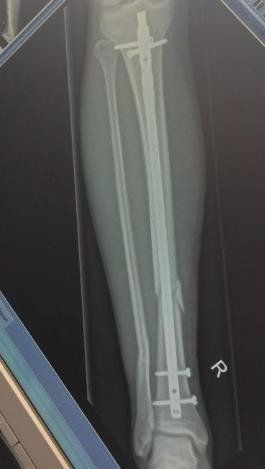 x-ray of fracture with fix