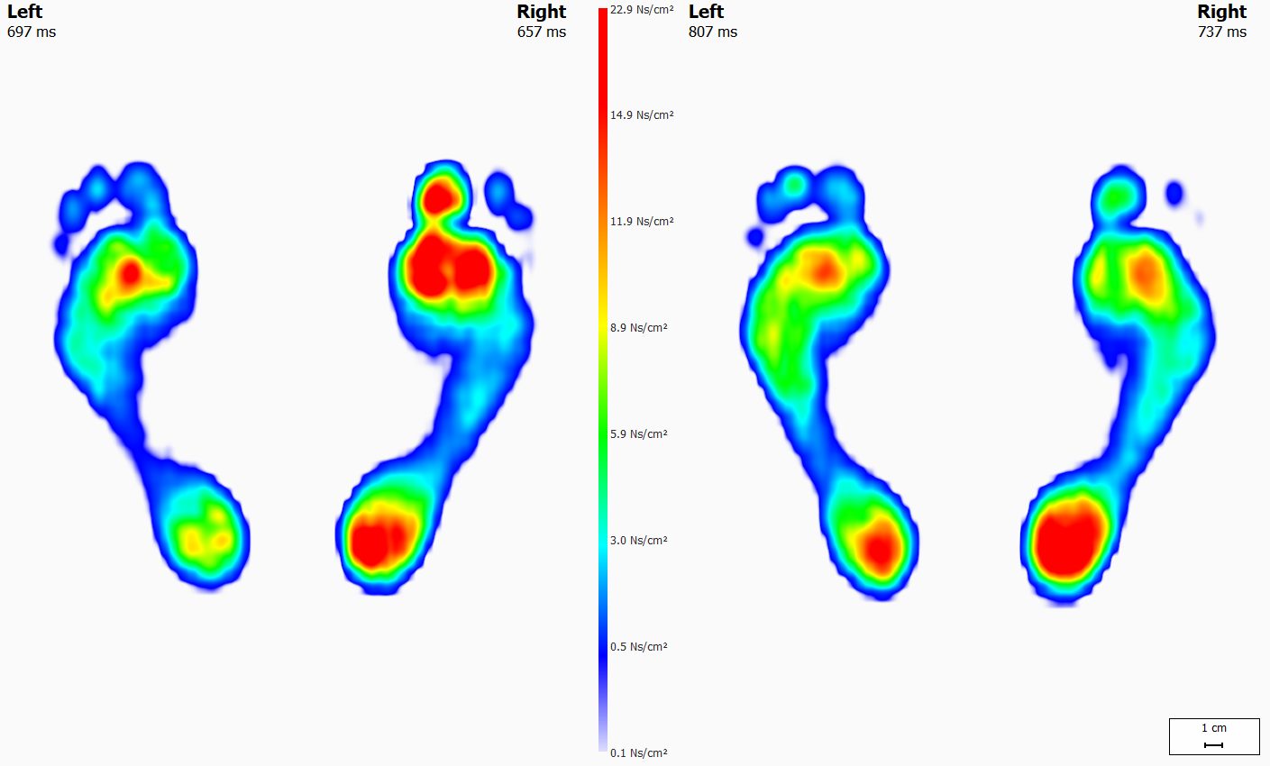 Footscan and Orthotics