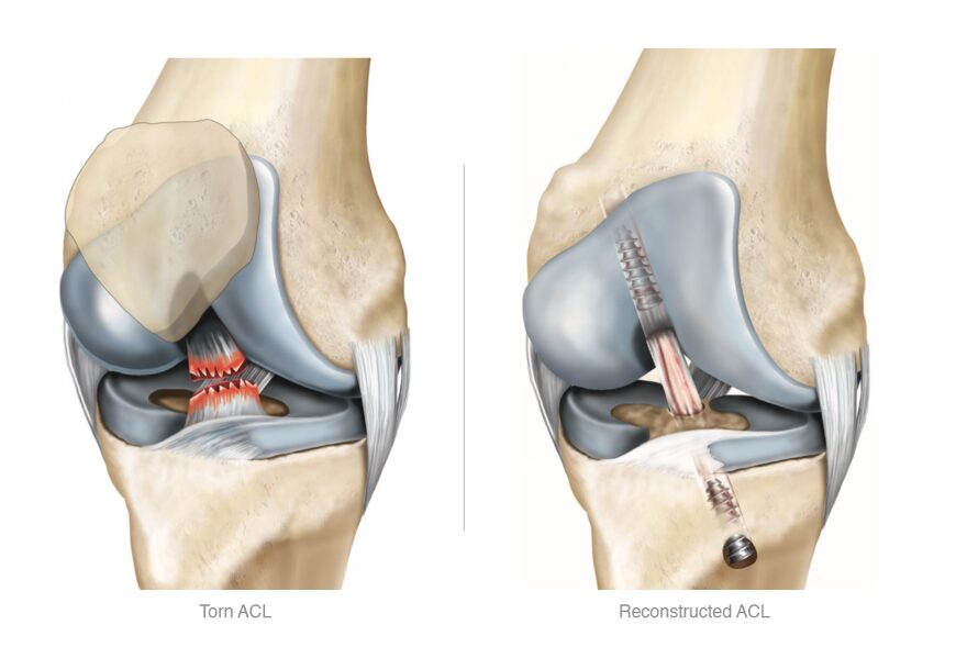 ACL injuries